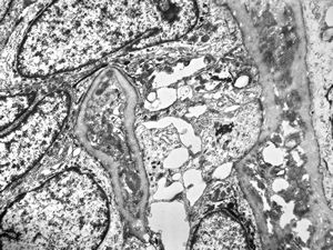 M,52y. | cylindroma - salivary gland